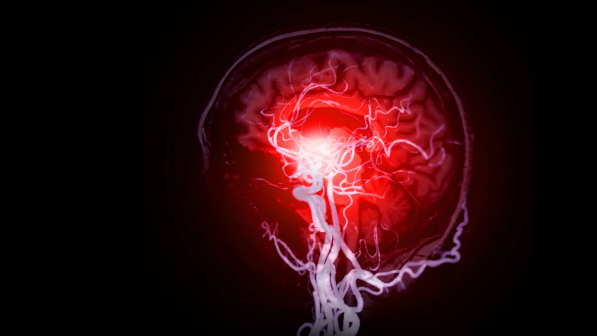 Featured image for Research Uncovers Hidden Brain Damage and Vascular Causes of Dementia