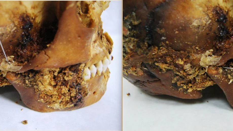 Ancient Scythian Jaw Surgery Revealed by 2,500-Year-Old Prosthetic