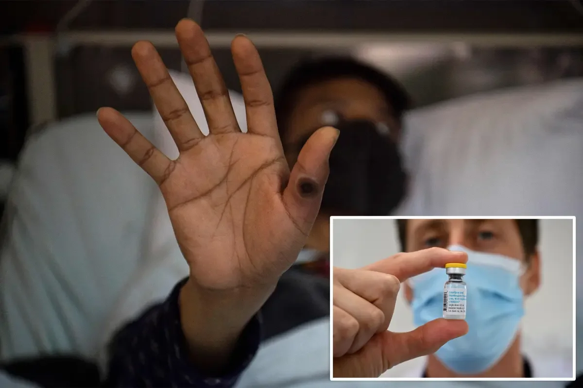 First severe mpox case (clade I) detected in NYC; vaccination urged for at-risk residents