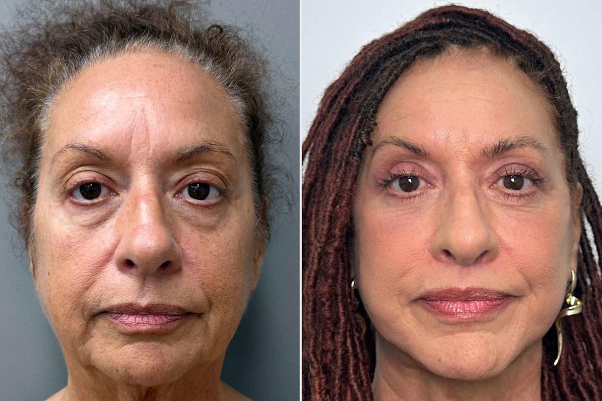 Featured image for 70-Year-Old Woman Shares Confidence Before Undergoing 8-Hour Dramatic Plastic Surgery