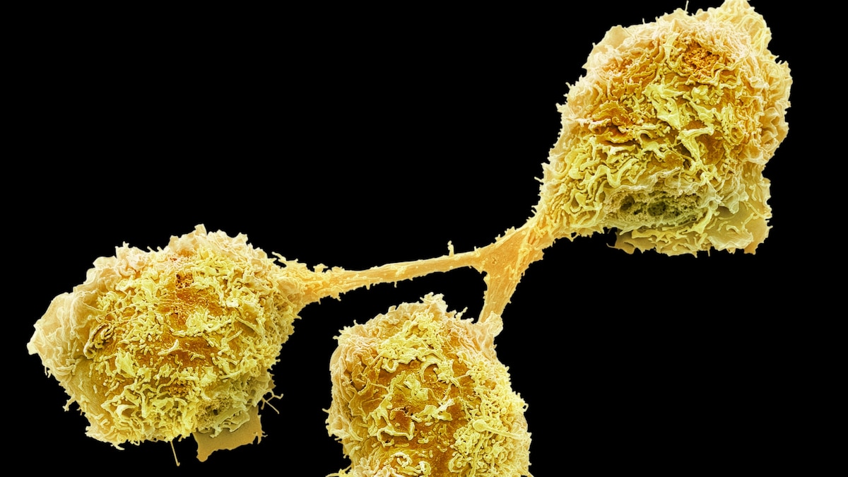 Unraveling the Mystery of COVID-19's Brain Fog: Scientists Make Breakthrough Discovery