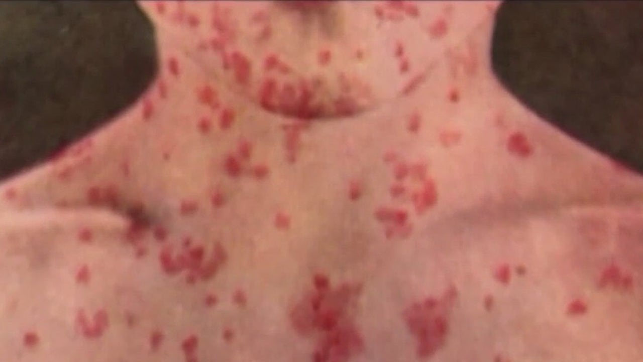 Featured image for "Measles Exposure Warning Issued for San Leandro Restaurant"