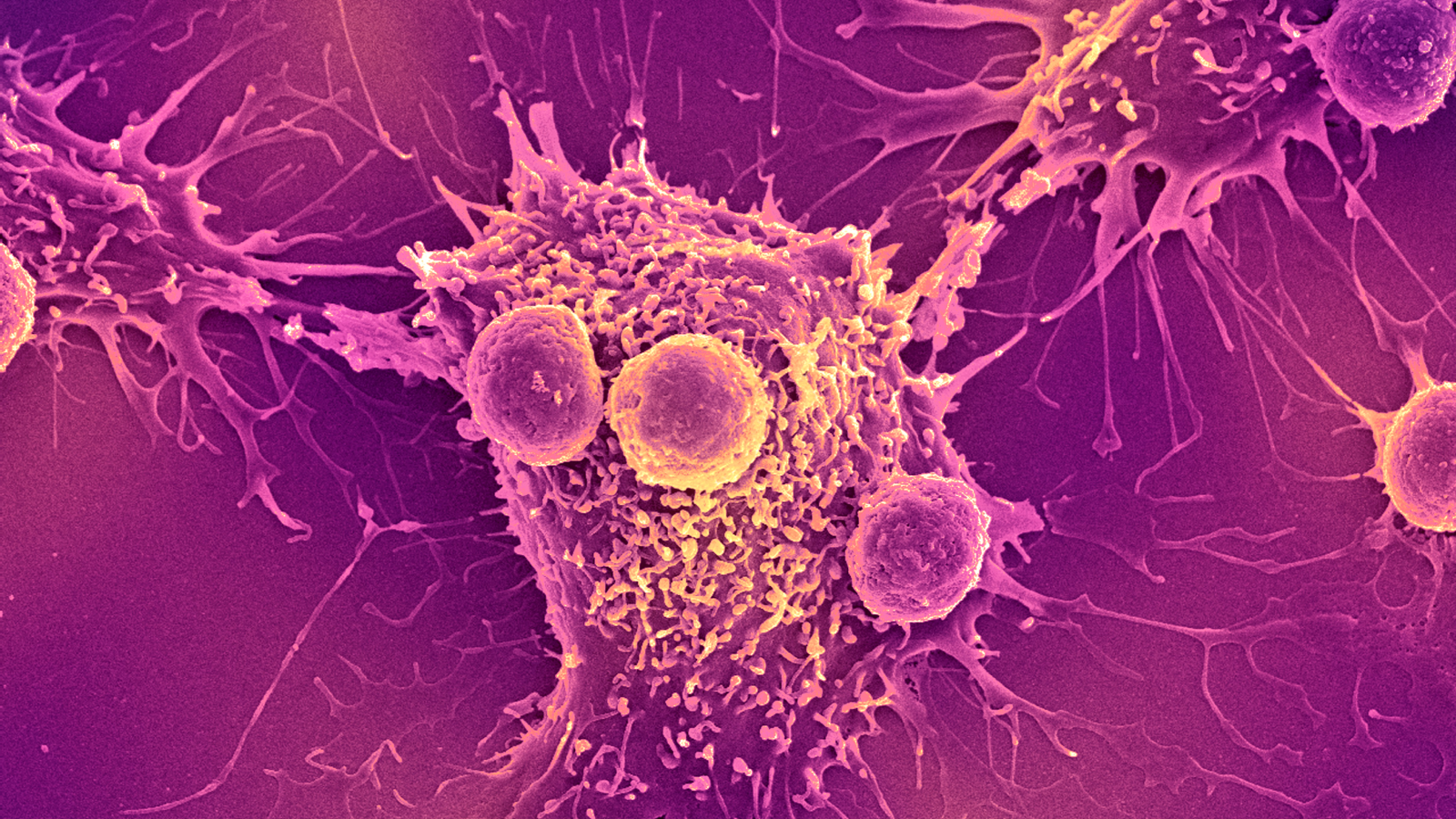 Featured image for Promising Advances in Universal Cancer Vaccine Development