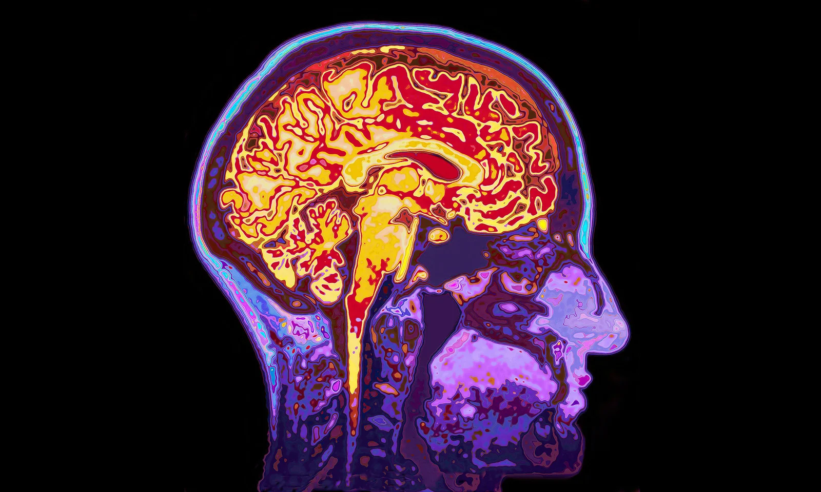 Microplastics Found Deep in Human Brains, More Common in Dementia Patients