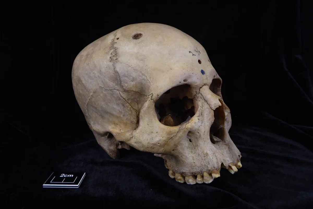 Featured image for Ancient Egyptian Skull Reveals Earliest Cancer Surgery Attempt