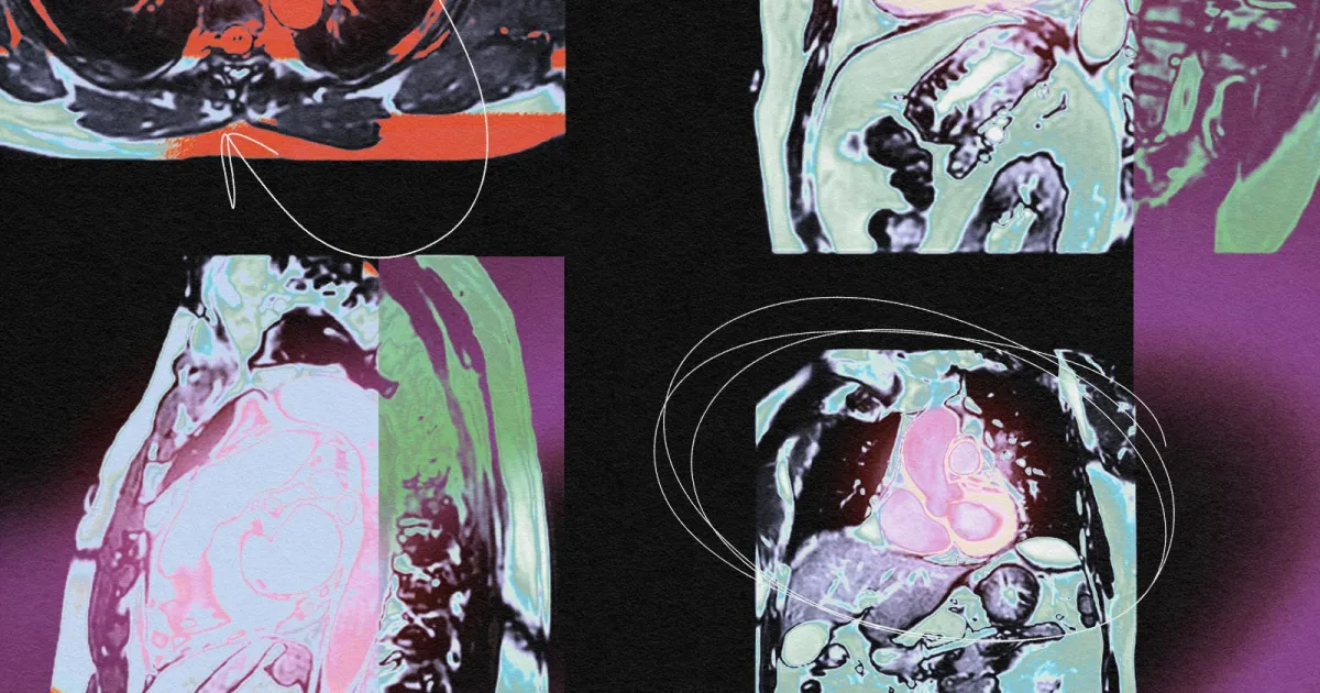 Featured image for "Groundbreaking Drug Slashes Heart Disease Risk by 96%"