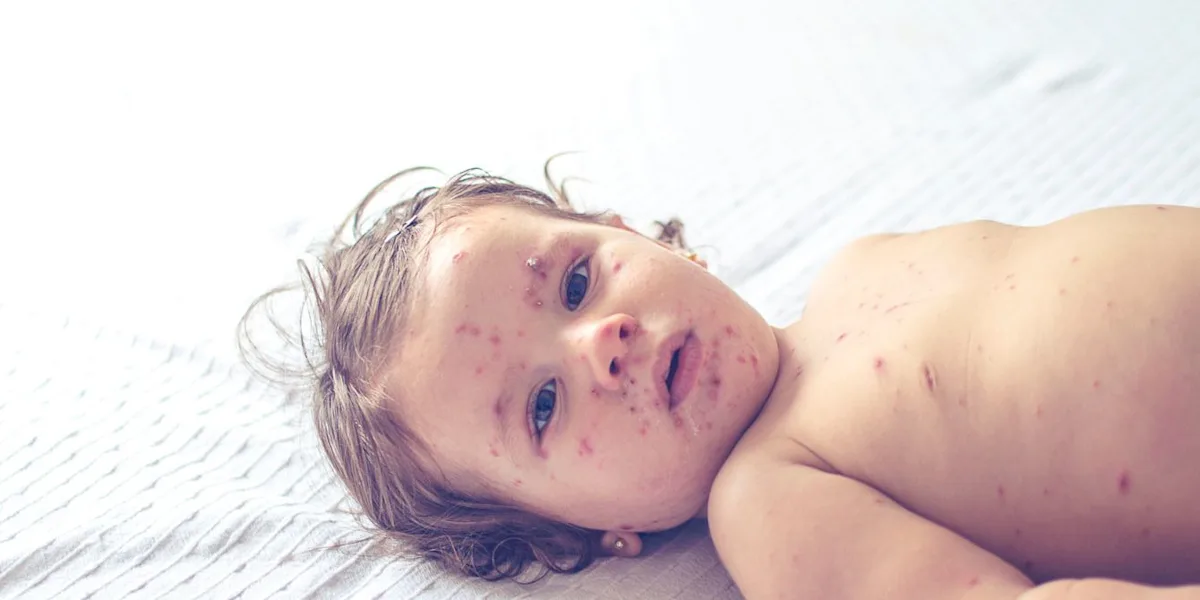 "Measles Outbreak Sparks Vaccine Hesitancy Concerns in Philadelphia and New Jersey"