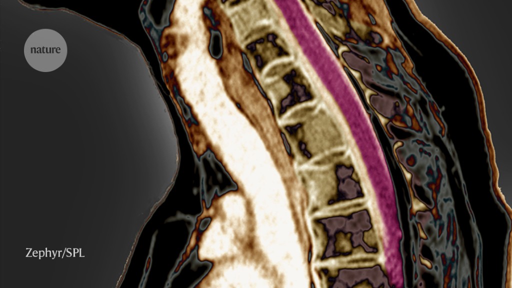 Uncovering the Link: Stem Cells Shed Light on Breast Cancer's Spinal Spread