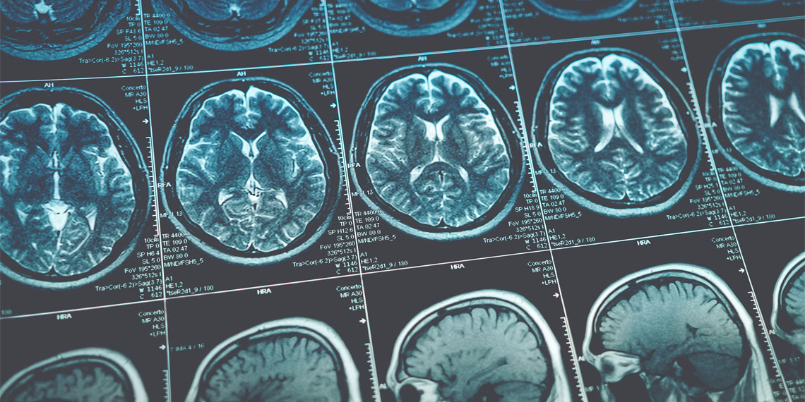 Study: No Severe White Matter Lesions Linked to MDMA Use in Humans