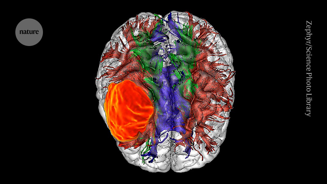 Featured image for Amino Acid Starvation Slows Brain Tumor Growth in Mice