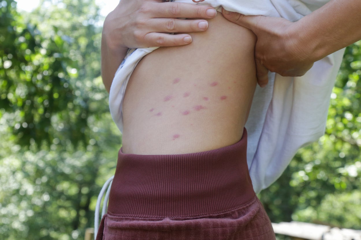 Featured image for Why Some People Are More Prone to Mosquito Bites
