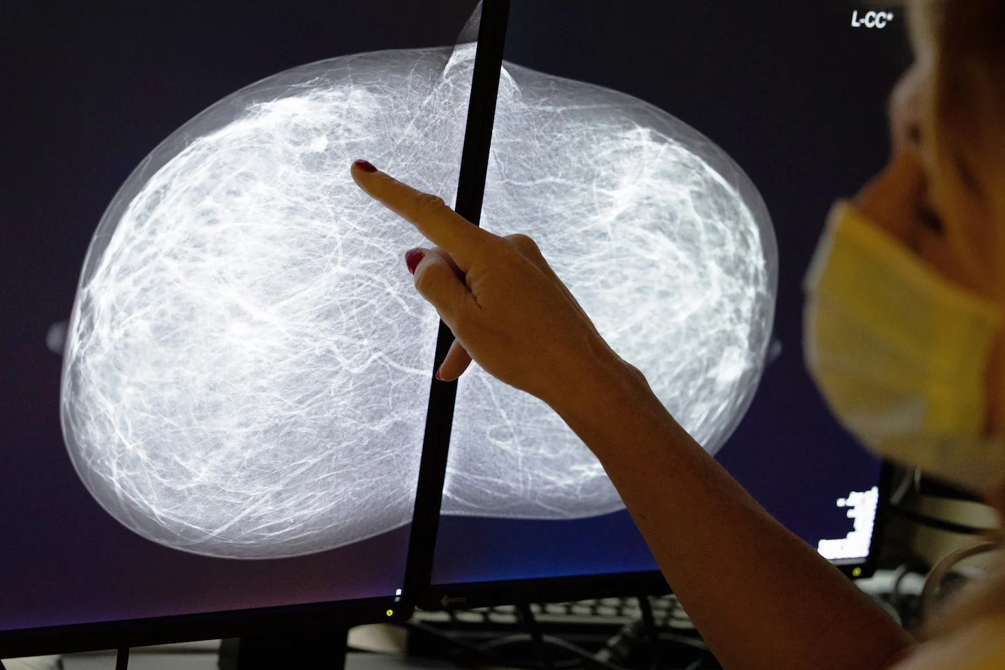 AI Turns Mammograms Into Early Warnings for Women’s Heart Health