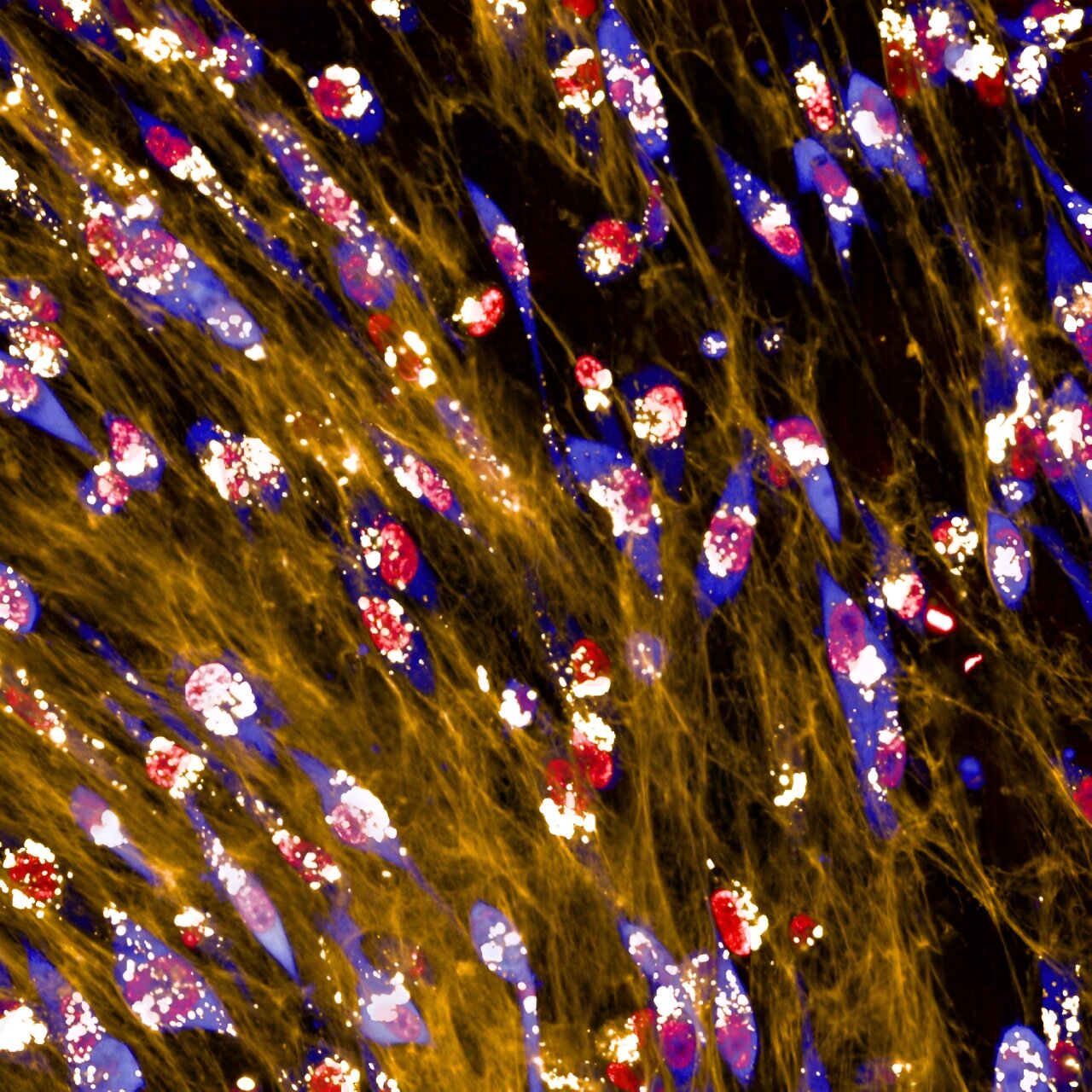 Featured image for "Breast Cancer Cells: Fueling Up by Consuming Surroundings, Study Finds"