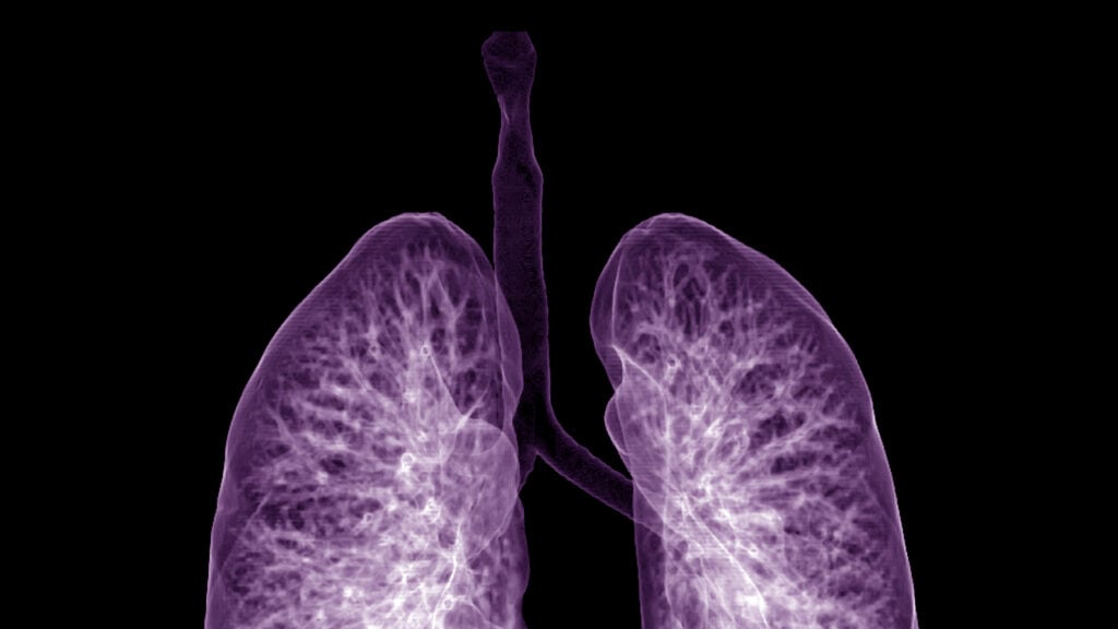 Featured image for Insmed Stock Soars After Successful Lung Disease Drug Trial