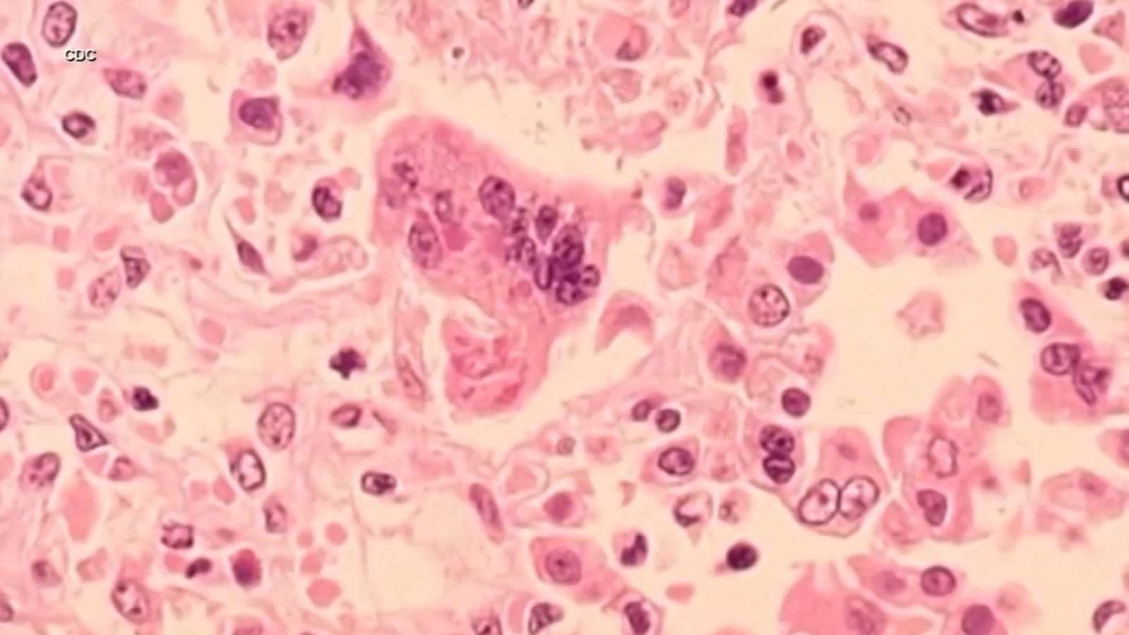 Measles Outbreak in East Bay Prompts Health Warnings