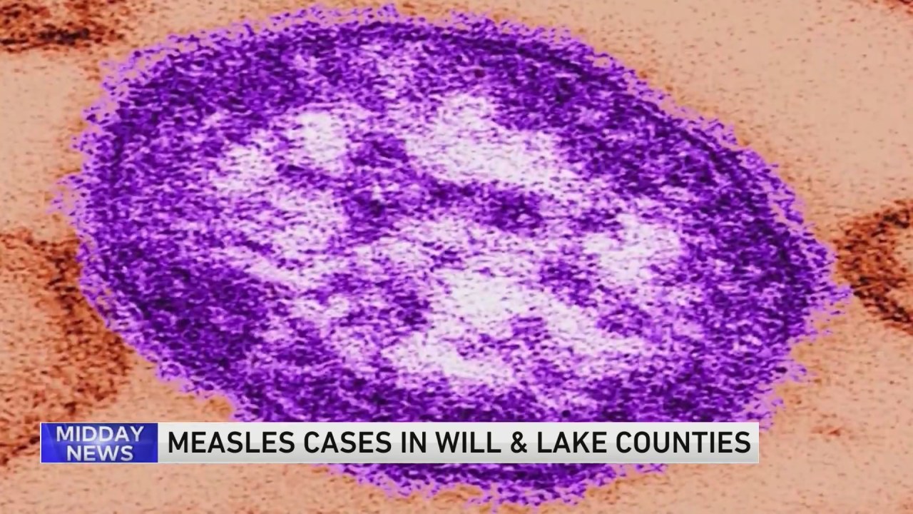 Featured image for Measles Case Linked to Chicago Outbreak Reported in Will County