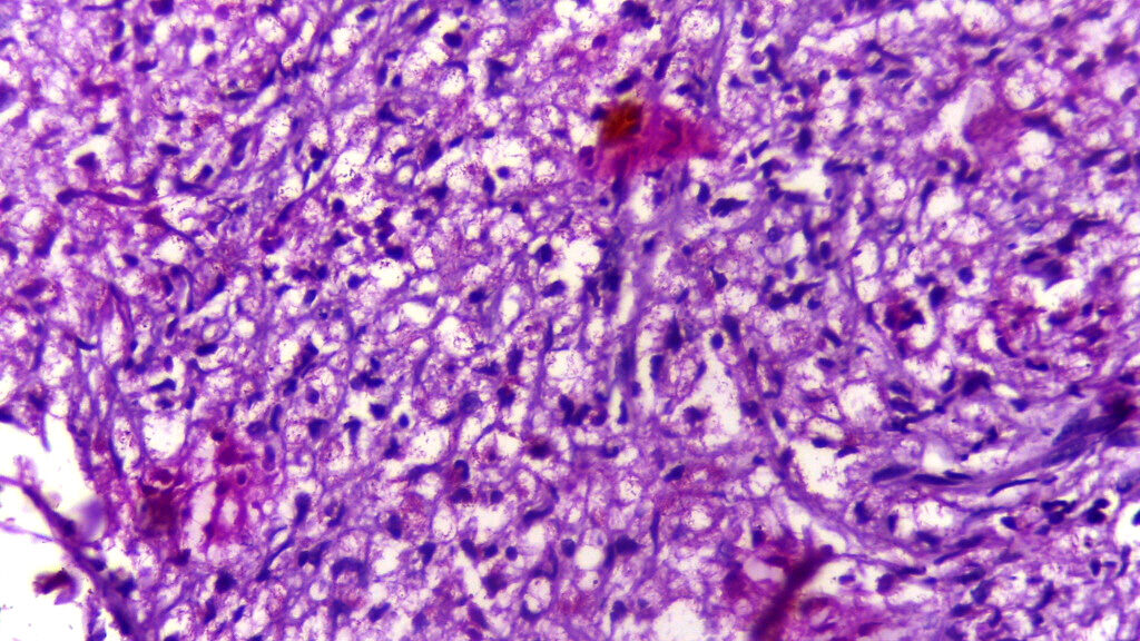 Featured image for Leprosy in Florida: Experts weigh in on the potential epidemic