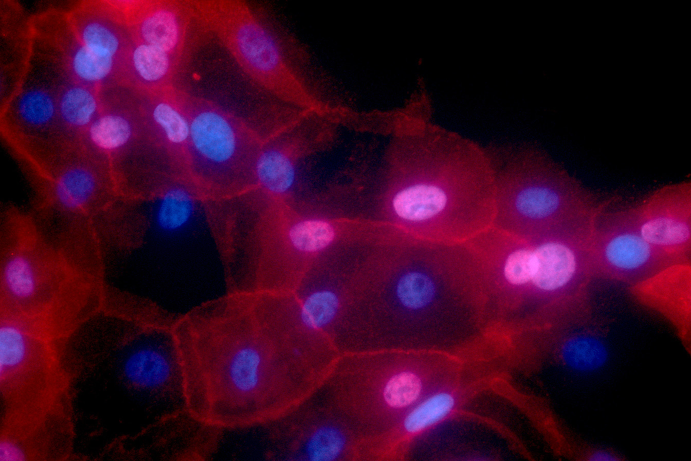 Innovative Tech Offers Surgeons Live Breast Cancer Insights