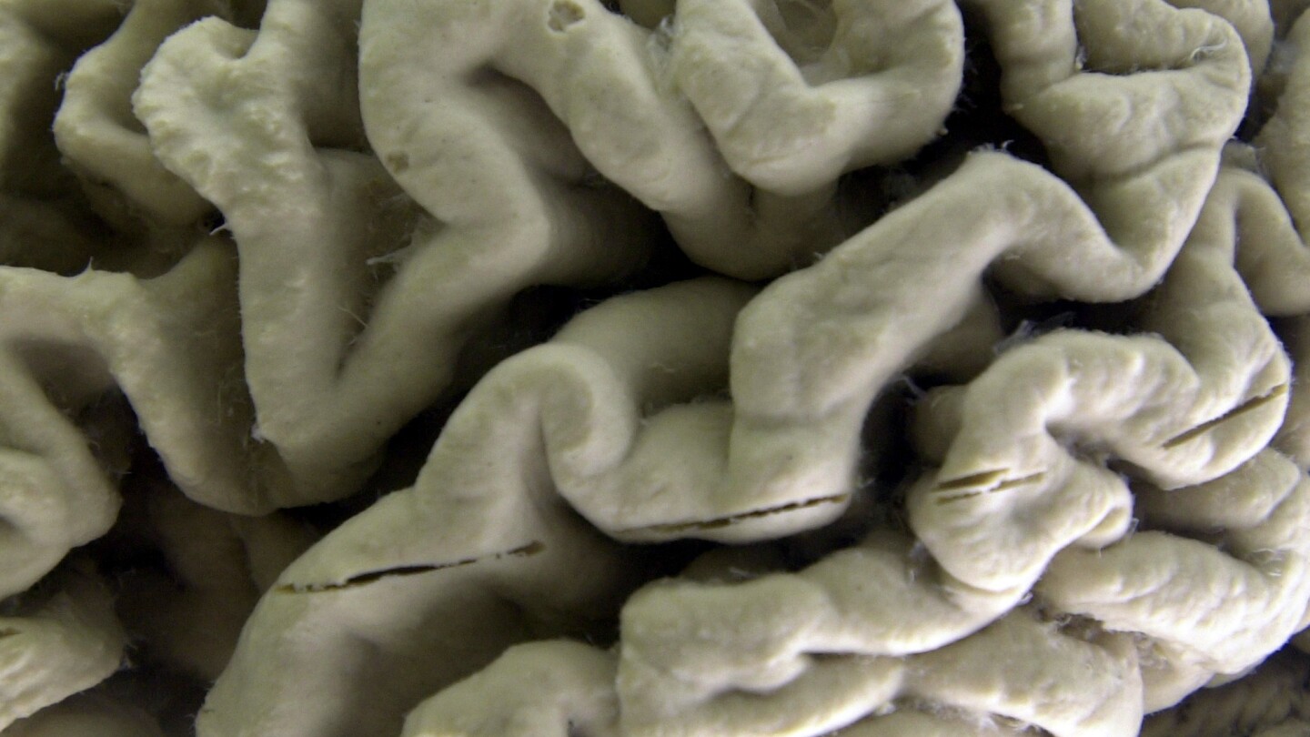 "Pre-Alzheimer's Silent Brain Changes Uncovered by Researchers"