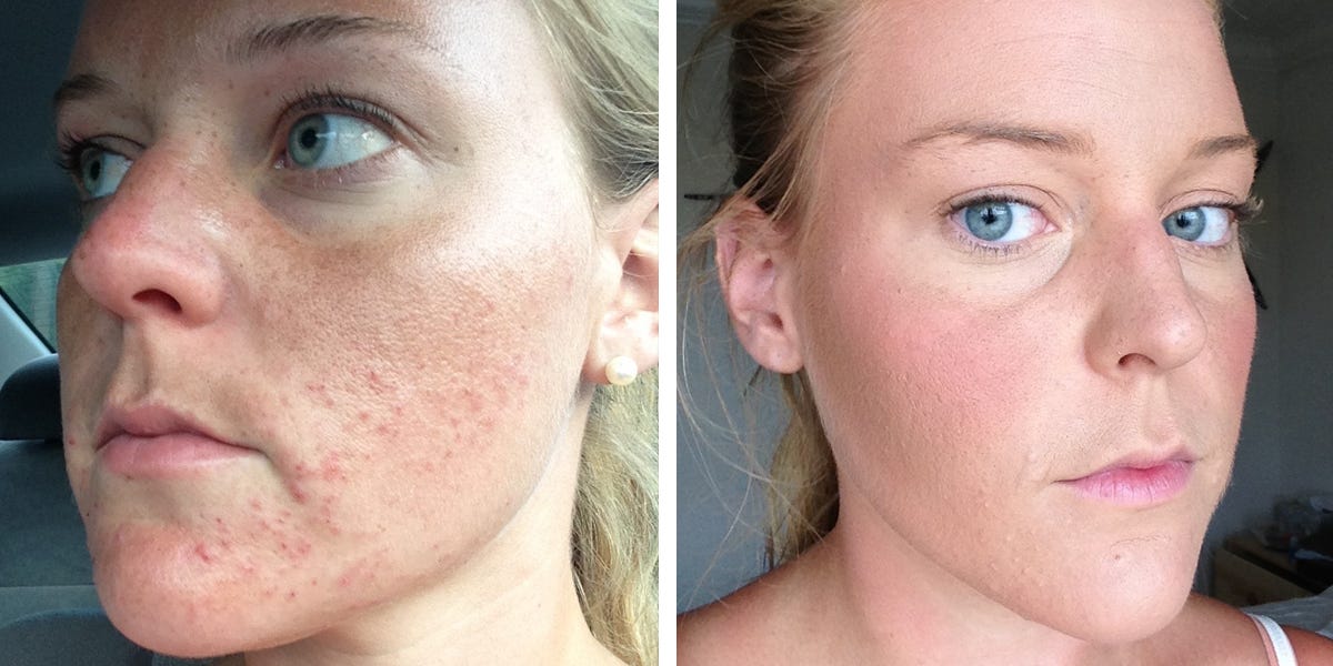 Pregnancy clears woman's treatment-resistant acne.