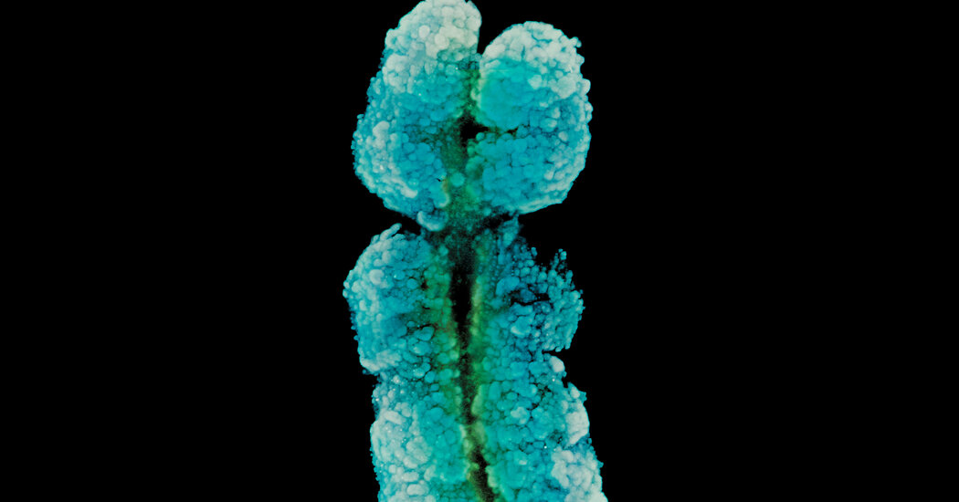 "Link Between X Chromosome and Increased Risk of Autoimmune Diseases in Women"
