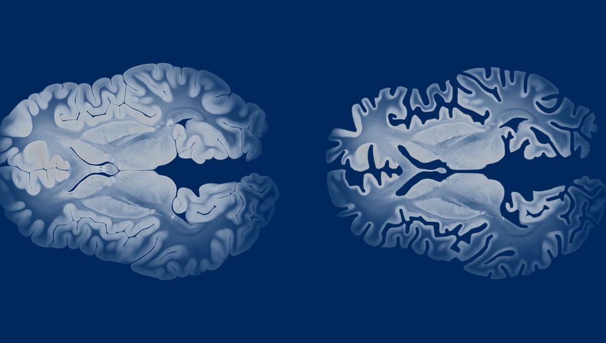 Featured image for New Breakthroughs Offer Hope for Reversing Alzheimer’s Disease