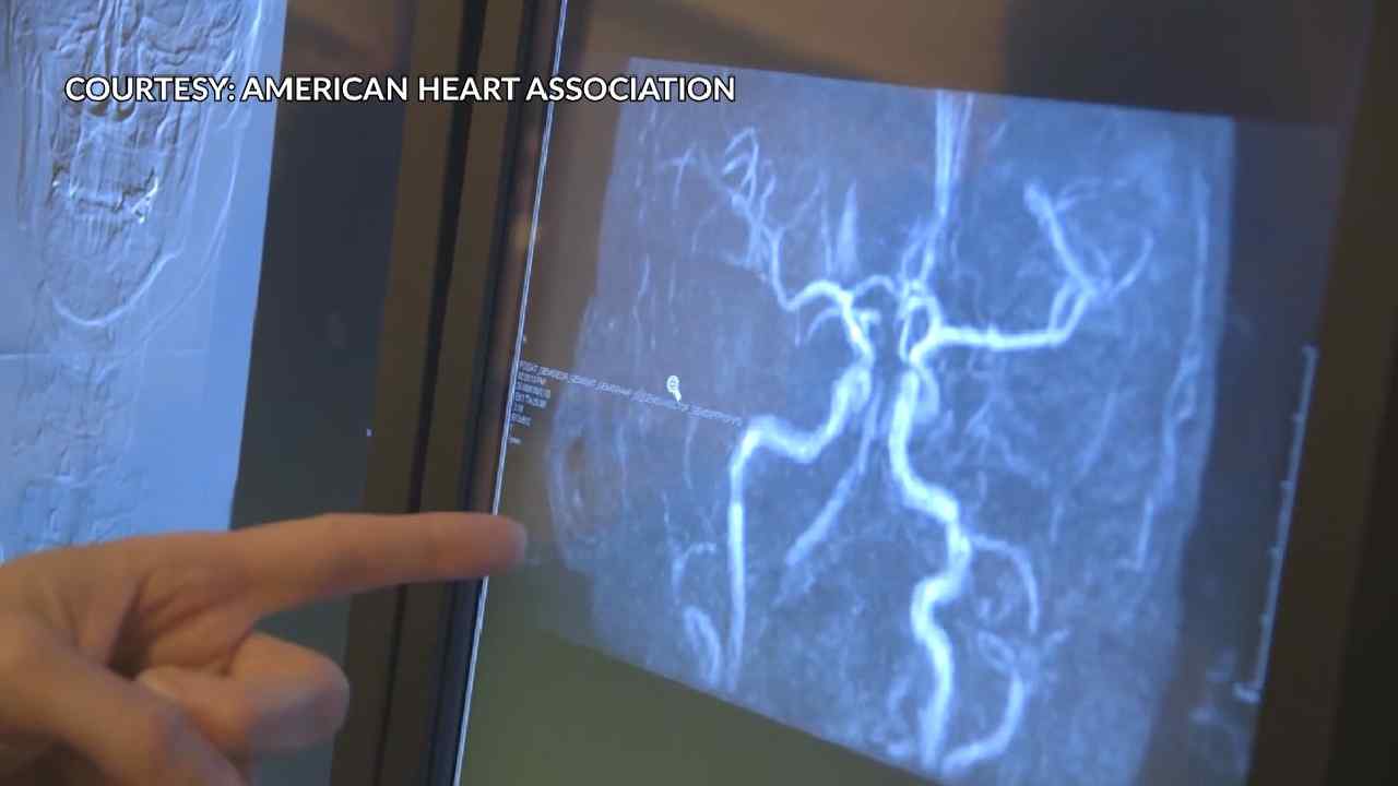 "World Stroke Day: Spotting Strokes and Saving Lives"