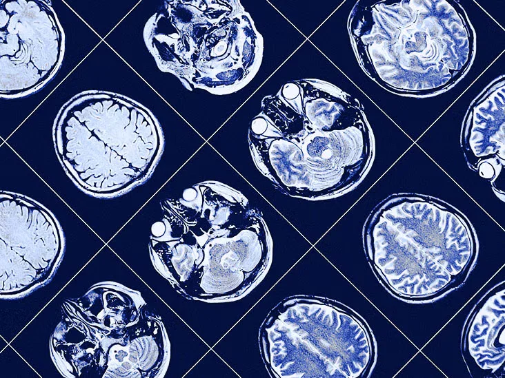 The Link Between Blood Sugar and Depression Risk in Diabetes