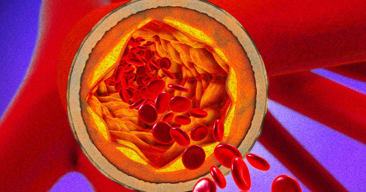 Featured image for "Gene-Edited Patient's Death Raises Concerns Over Cholesterol Treatment"