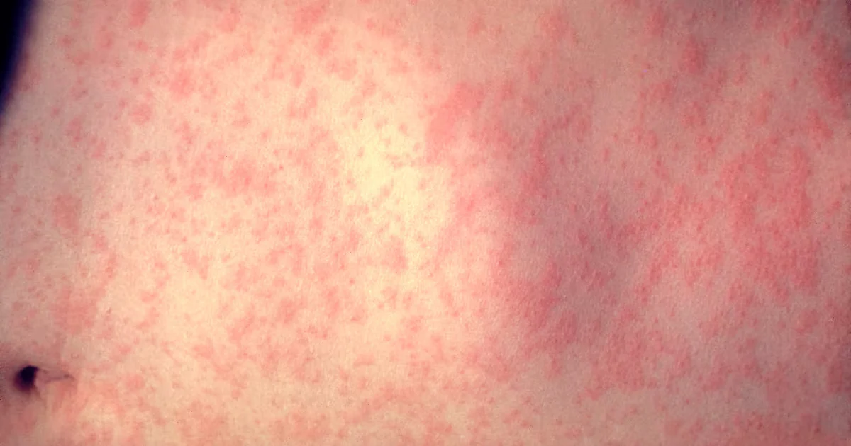Georgia Reports Second Measles Case This Year in Unvaccinated Resident