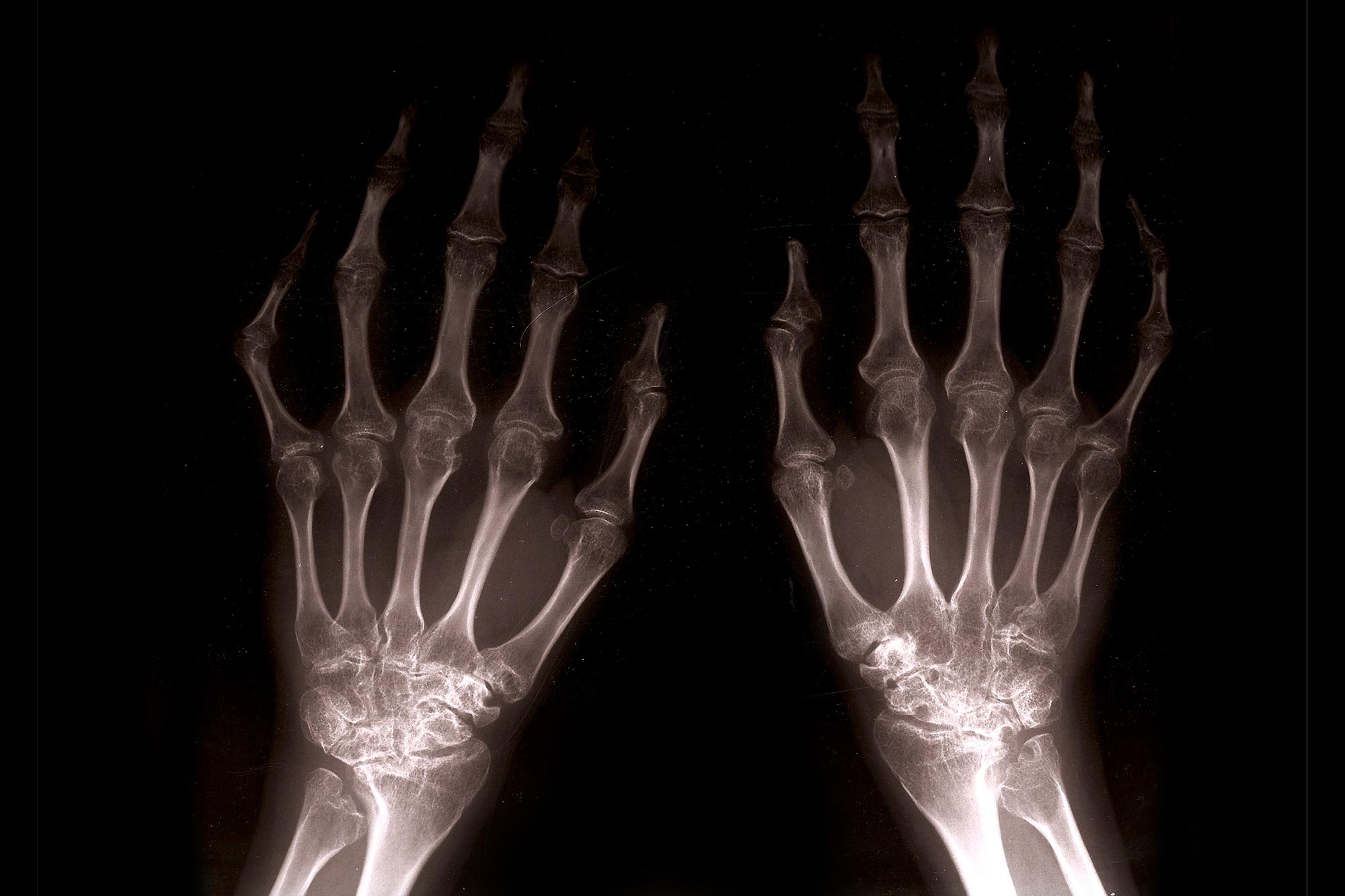 Featured image for "Thunder God Vine: A Natural Remedy for Arthritis"