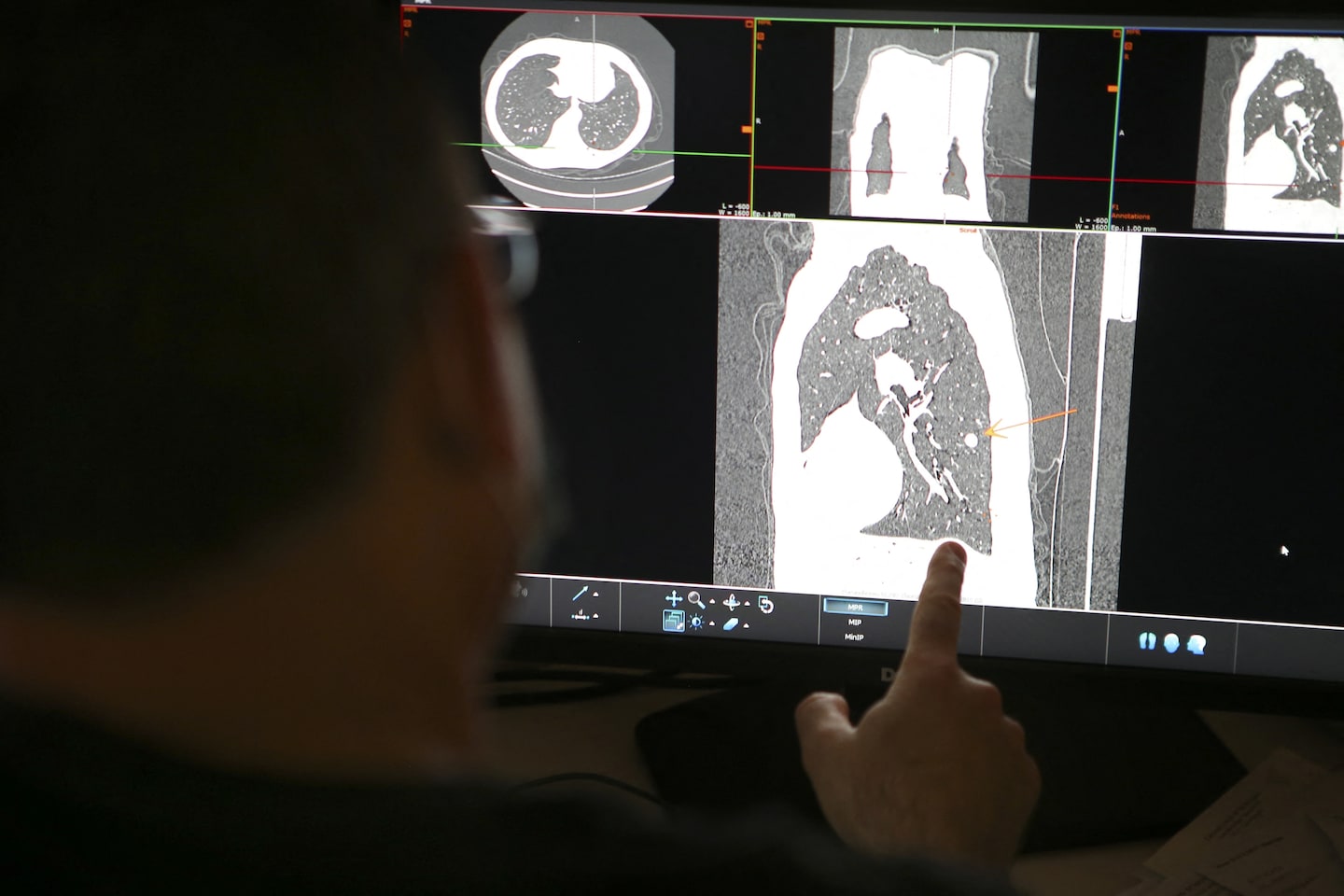 Featured image for Improving Lung Cancer Survival Rates Highlight Racial Inequality and Low Screening Rates