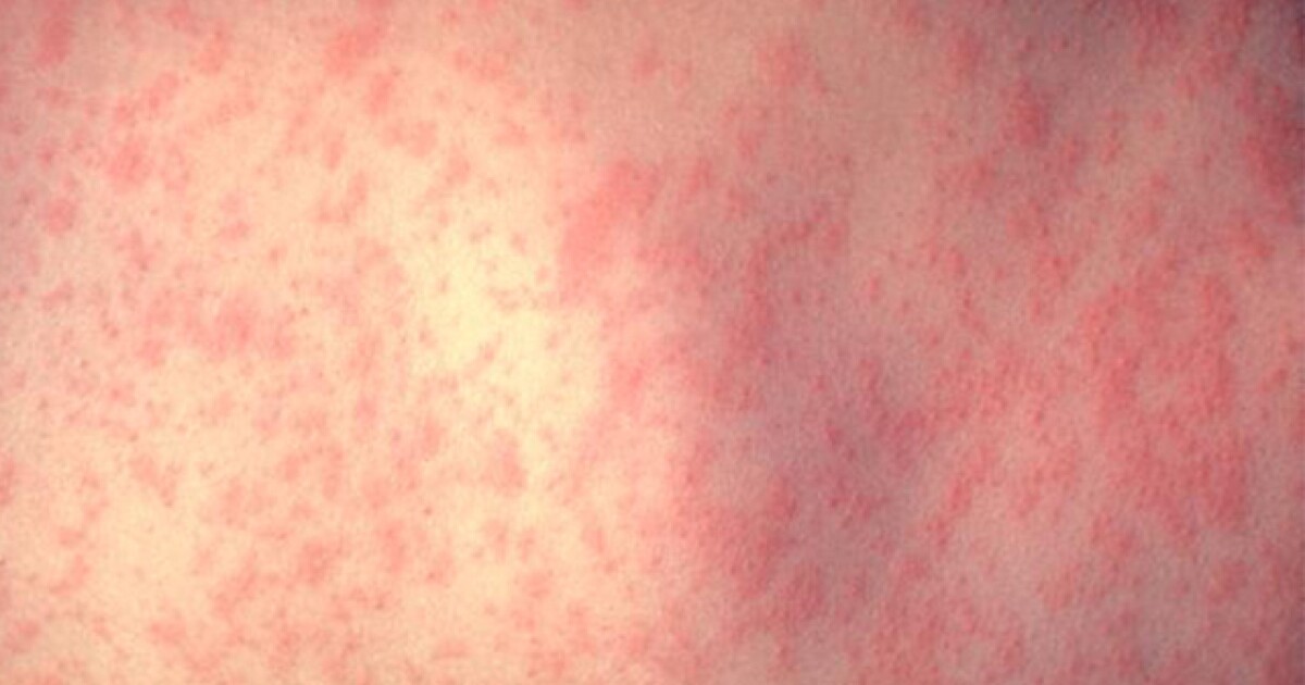 Featured image for "Measles Outbreak Prompts Urgent Vaccination Recommendations in Metro Detroit"