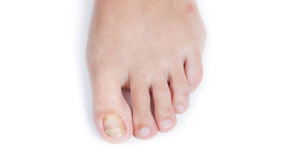 Featured image for Effective Solutions for Thick, Discolored Toenails and Toenail Fungus