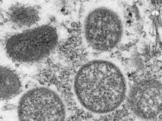 Featured image for "Wake County Urges Increased JYNNEOS Vaccination Amid New Monkeypox Cases"