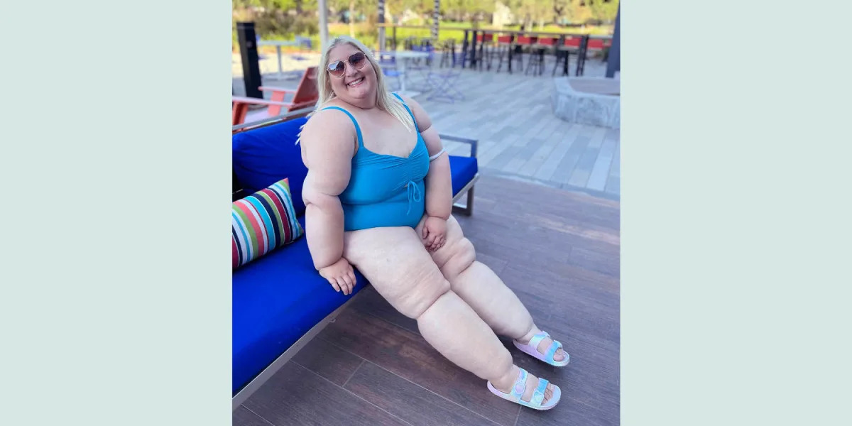 Featured image for Overcoming Lipedema: Woman's Journey from Dismissal to Triumph