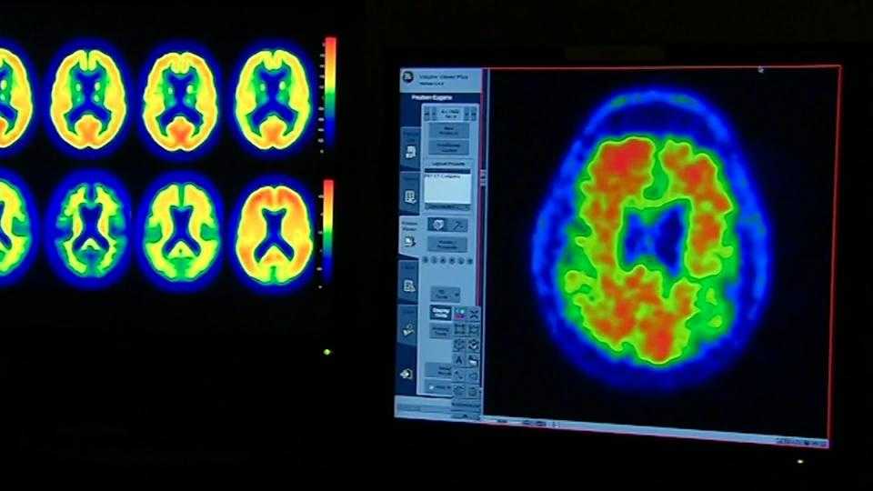 Reducing Alzheimer's impact on Black families.