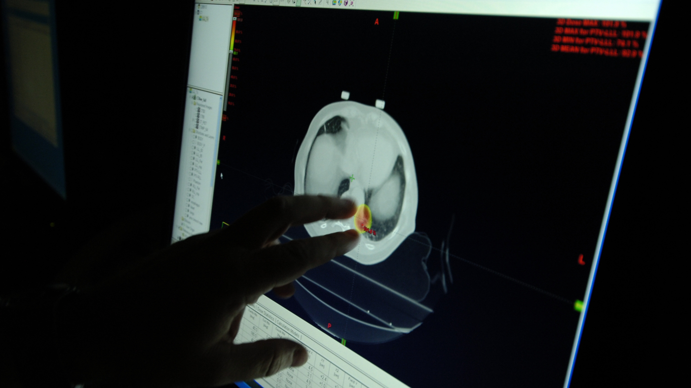 Improving Lung Cancer Survival Rates: Overcoming Barriers and Increasing Screening