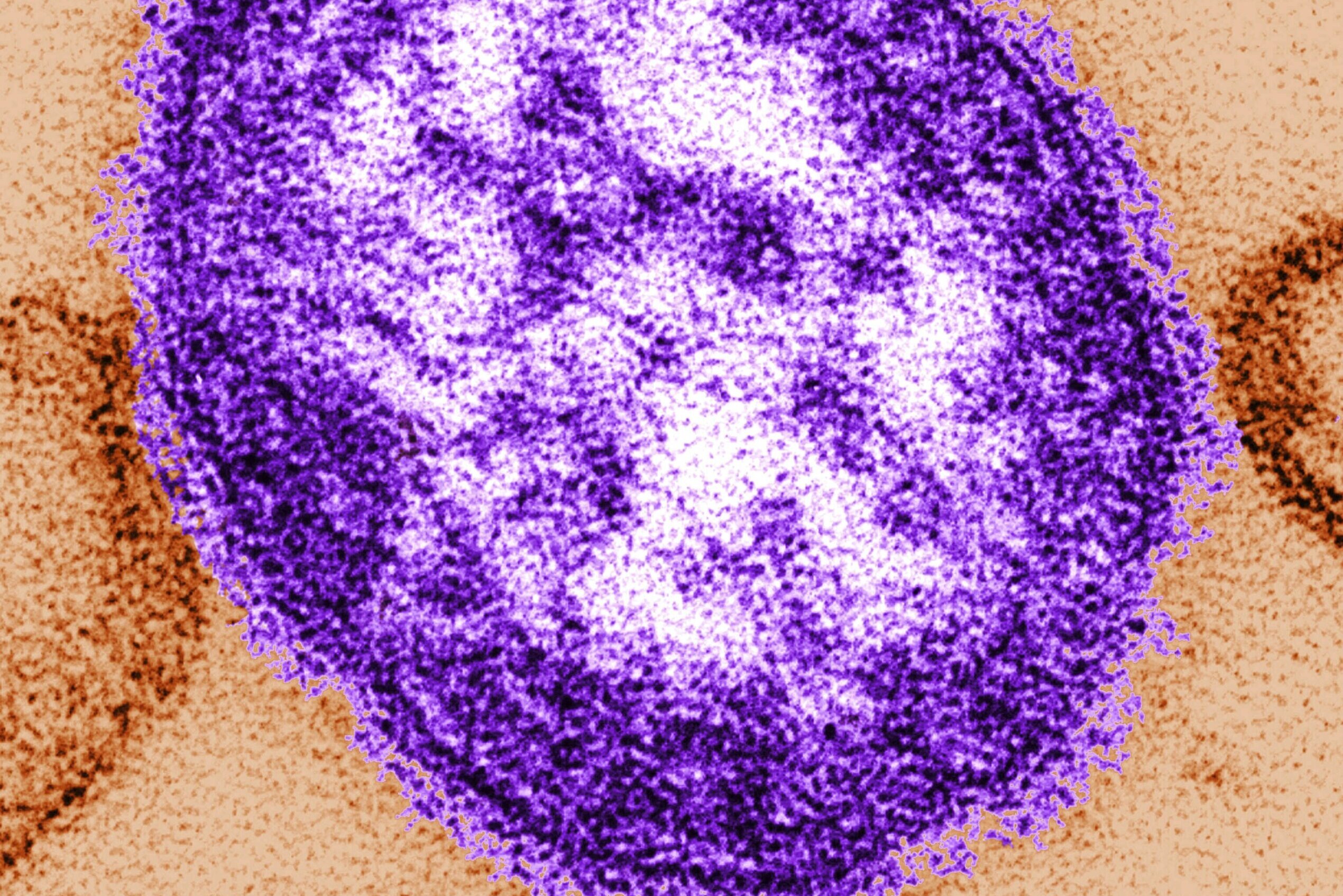 Featured image for Measles Exposure Confirmed at Dulles Airport, Northern Virginia