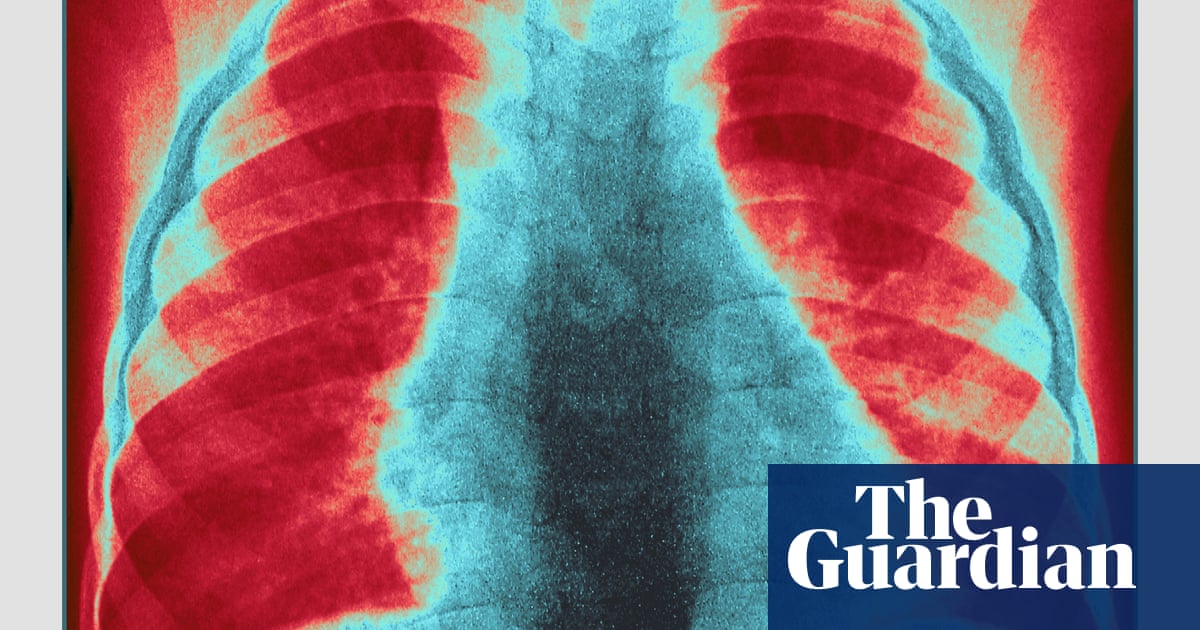 "London Faces Major Measles Outbreak Risk, Warns Health Security Agency"