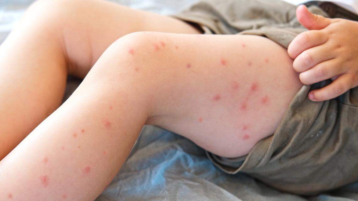 Featured image for South Carolina Measles Outbreak Expands, Raising Public Health Concerns