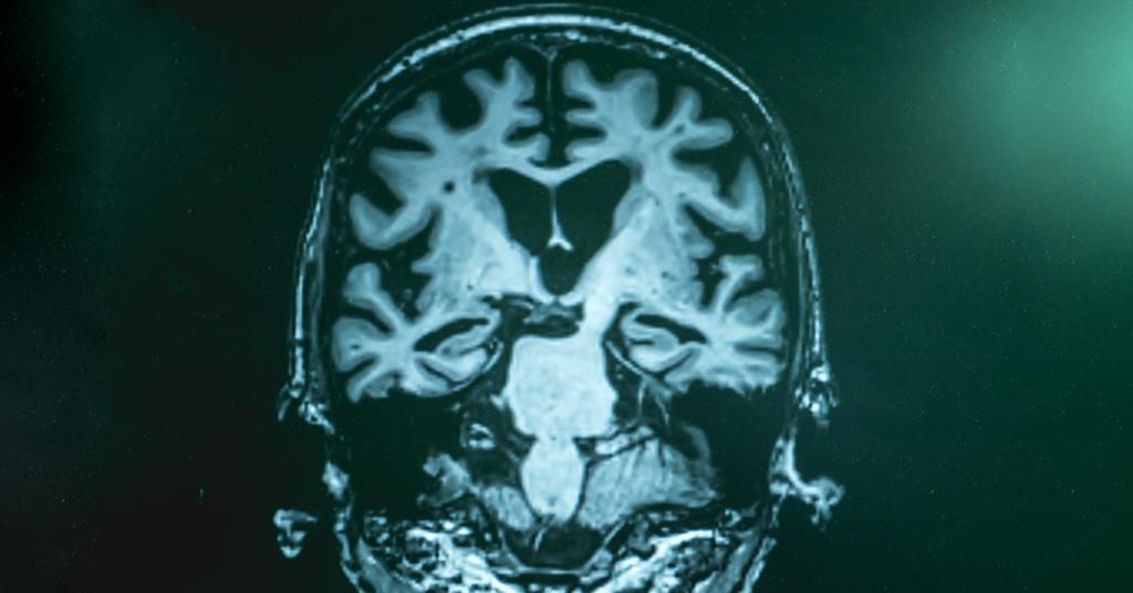 Featured image for "Unprecedented Discovery: Medical Transmission of Alzheimer's Disease Uncovered"