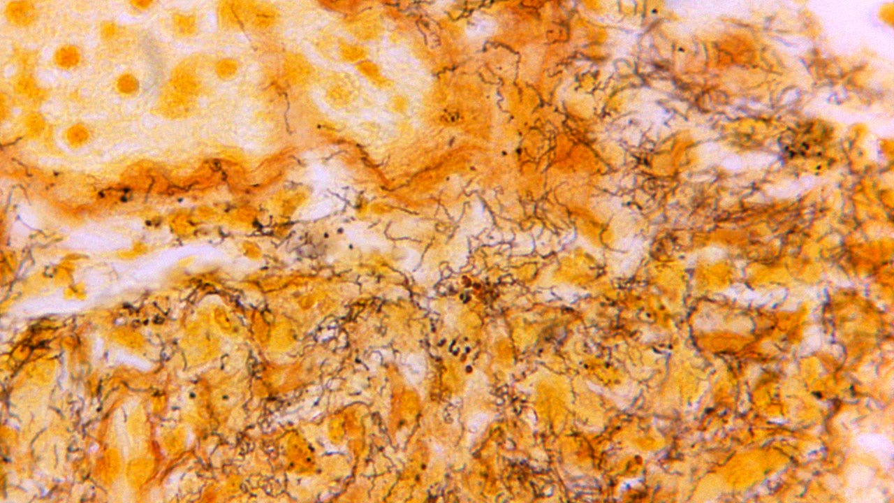 "Syphilis Surges in the US Amid Drug Shortage and Budget Cuts"