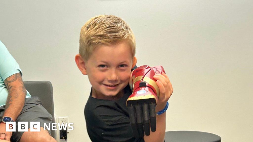 Five-Year-Old Becomes Youngest Recipient of Bionic Hero Arm