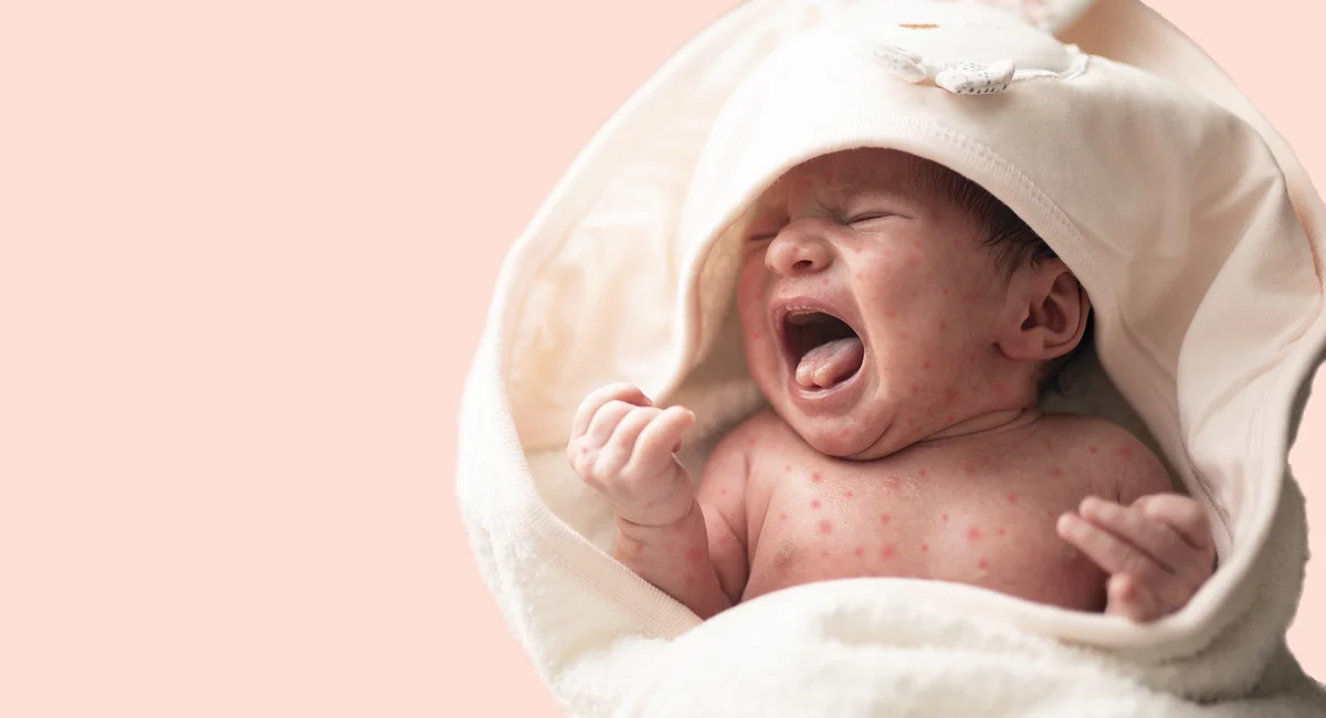 Featured image for "Measles Resurgence in NYC as Child Vaccination Rates Decline"