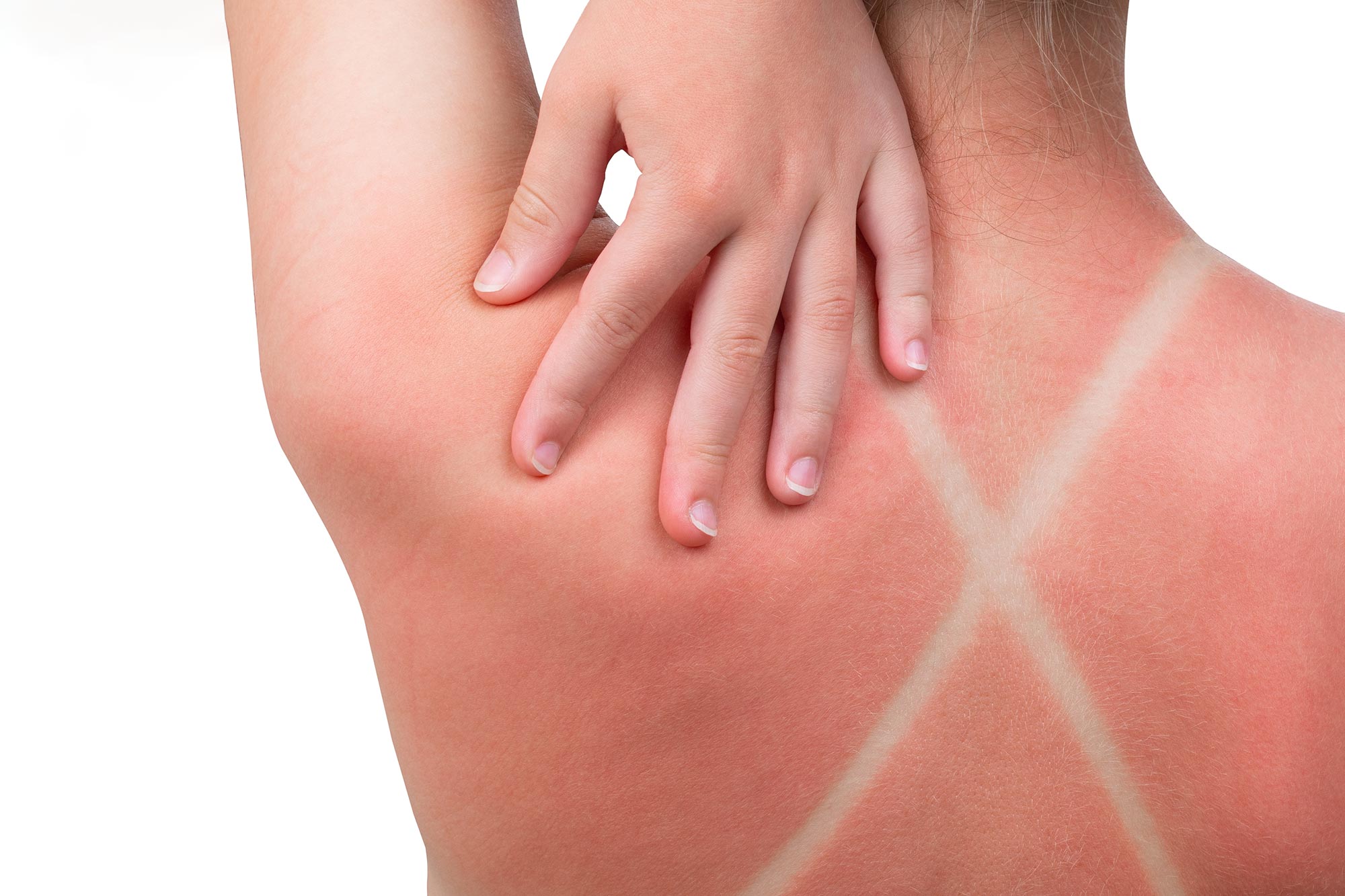 Featured image for Sunburn May Activate Hidden Cancer Pathway, Scientists Find