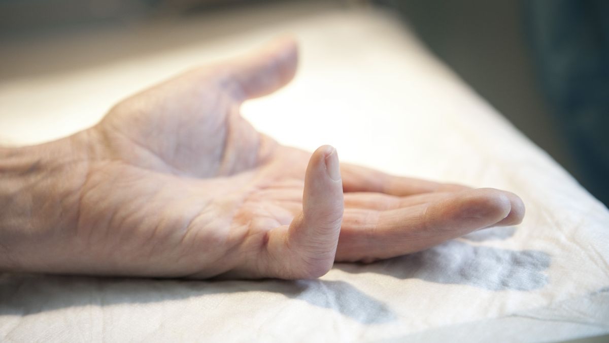 Featured image for Neanderthal DNA linked to hand disorder and longevity breakthrough.