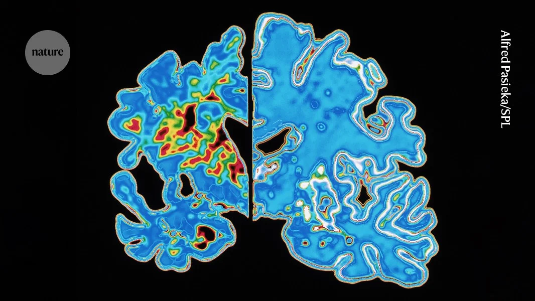 Blood tau clock could forecast when Alzheimer’s symptoms begin