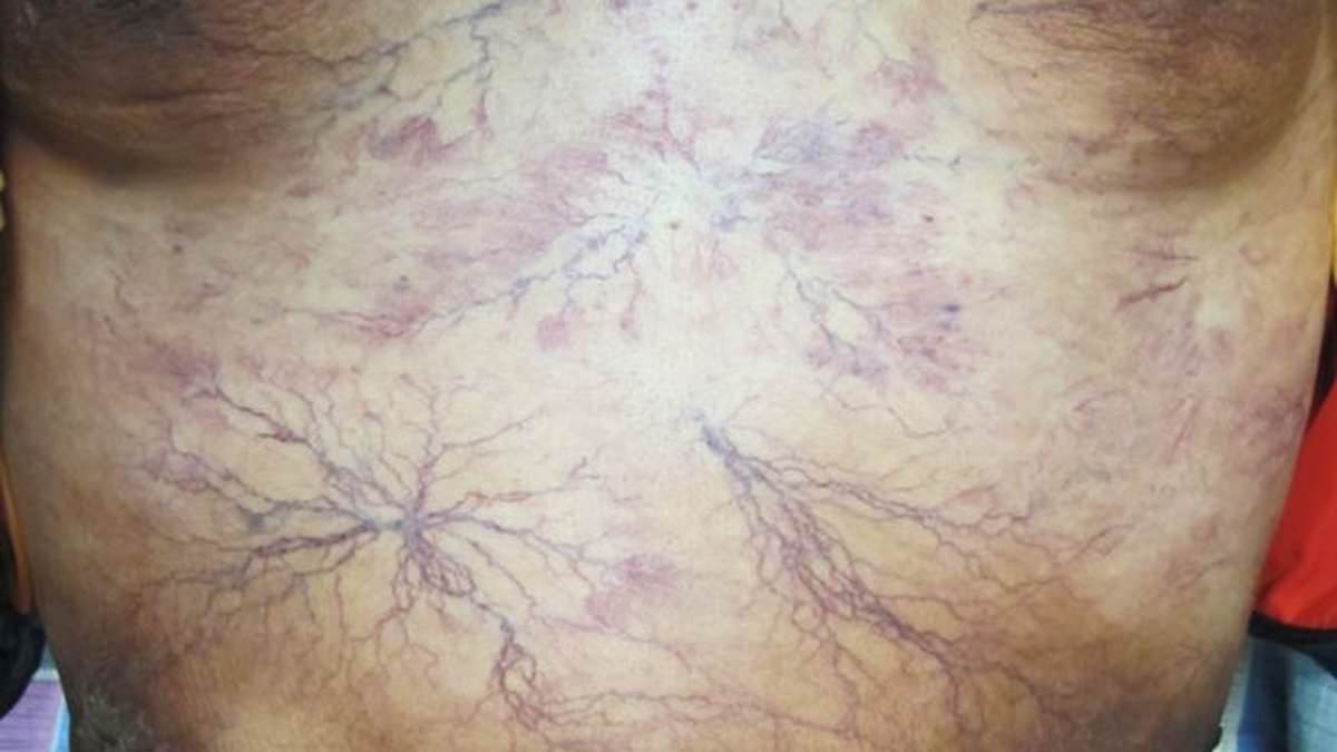 Featured image for Varicose Veins: A Potential Indicator of Cancer, Doctors Warn