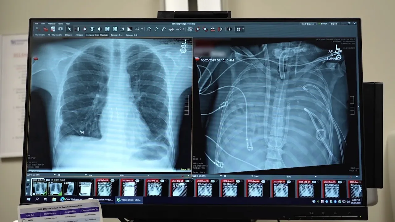 Patient survives 48 hours on a total artificial lung before double-lung transplant